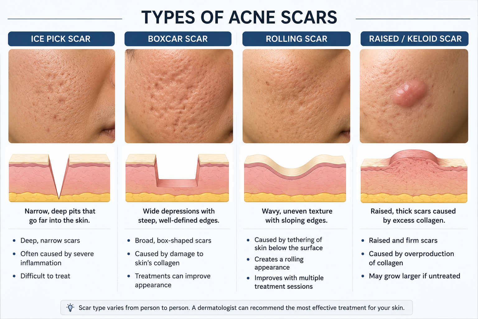 Infographic comparing ice pick, boxcar, rolling, and raised acne scars
