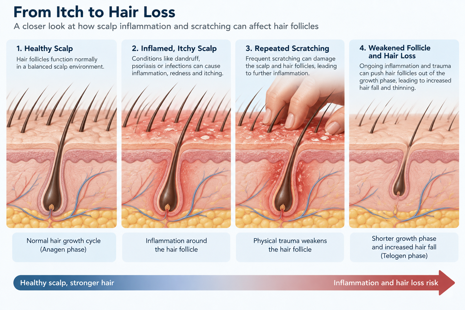 Illustration showing inflamed scalp and hair follicle irritation